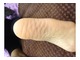 Foot after callous peel